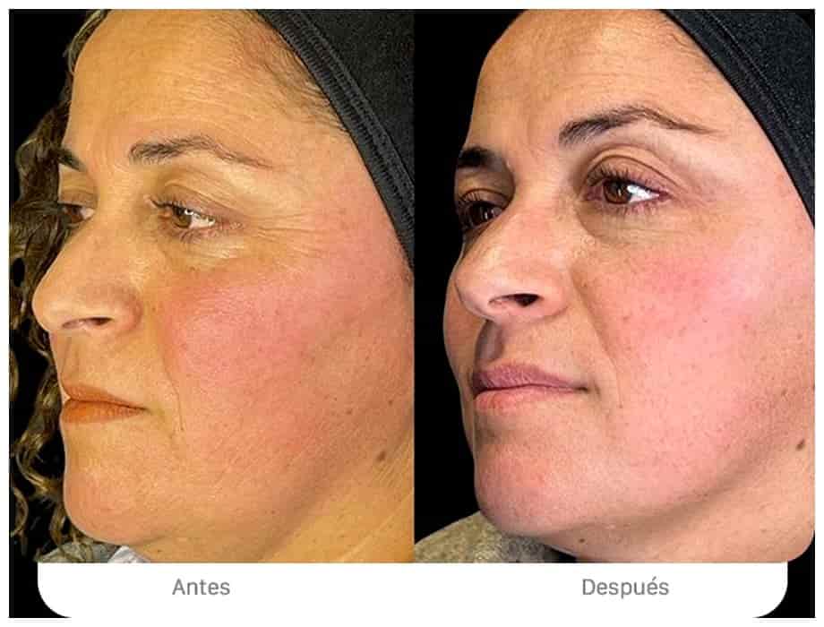 Tratamiento de bio armonización facial con HIFU - firmeza y rejuvenecimiento